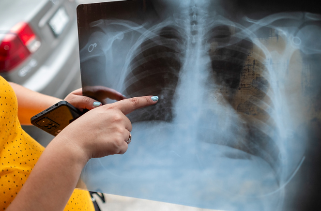 Elena Marisol Izaguirre muestra una radiografía de sus pulmones; se pregunta si la contaminación explica en parte sus problemas respiratorios. Foto: Bernardo De Niz/Quinto Elemento Lab